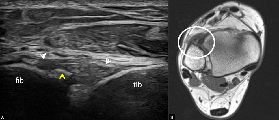 Sindesmosis tibioperonea tempo formacion ecografia 8.jpg